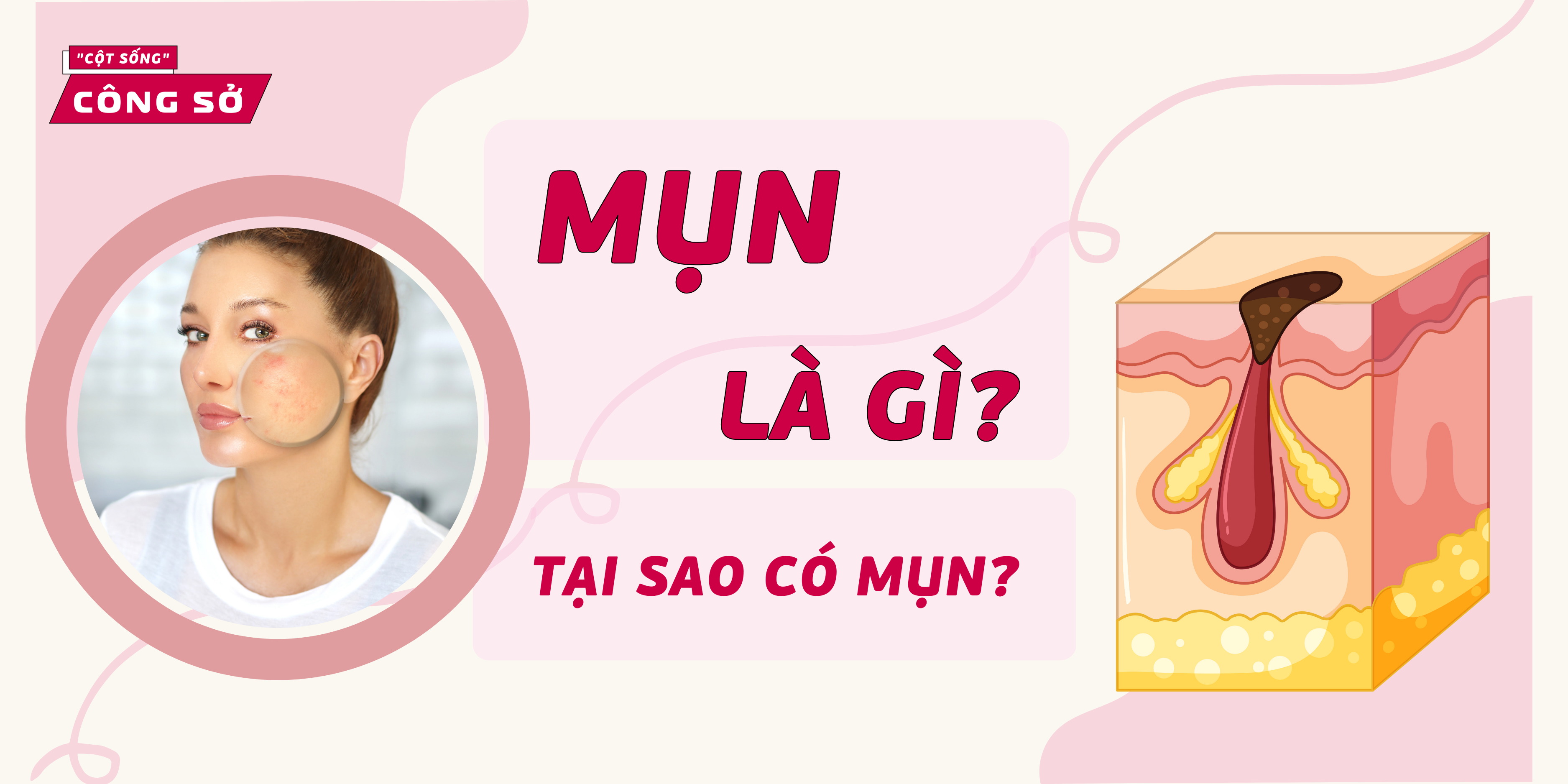 Mụn là gì? Tại sao có mụn?... 
